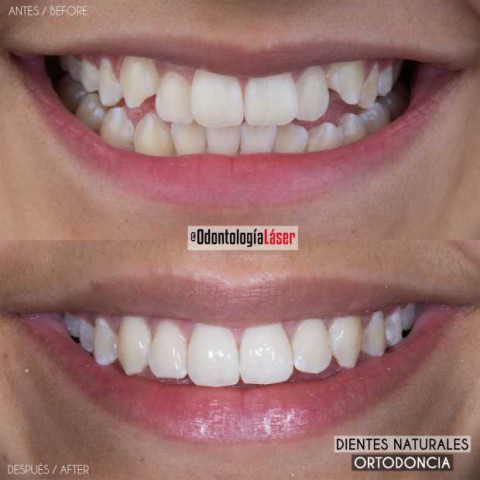 ¿El diseño de sonrisa daña tus dientes?